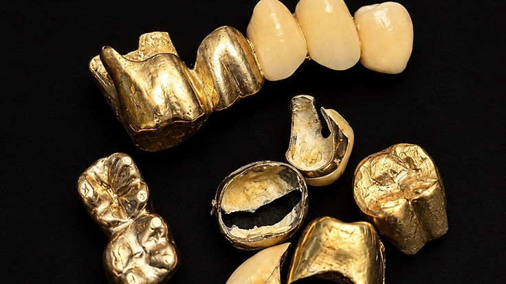 Zahngold: Goldkronen und eine Brücke, teils mit Keramik