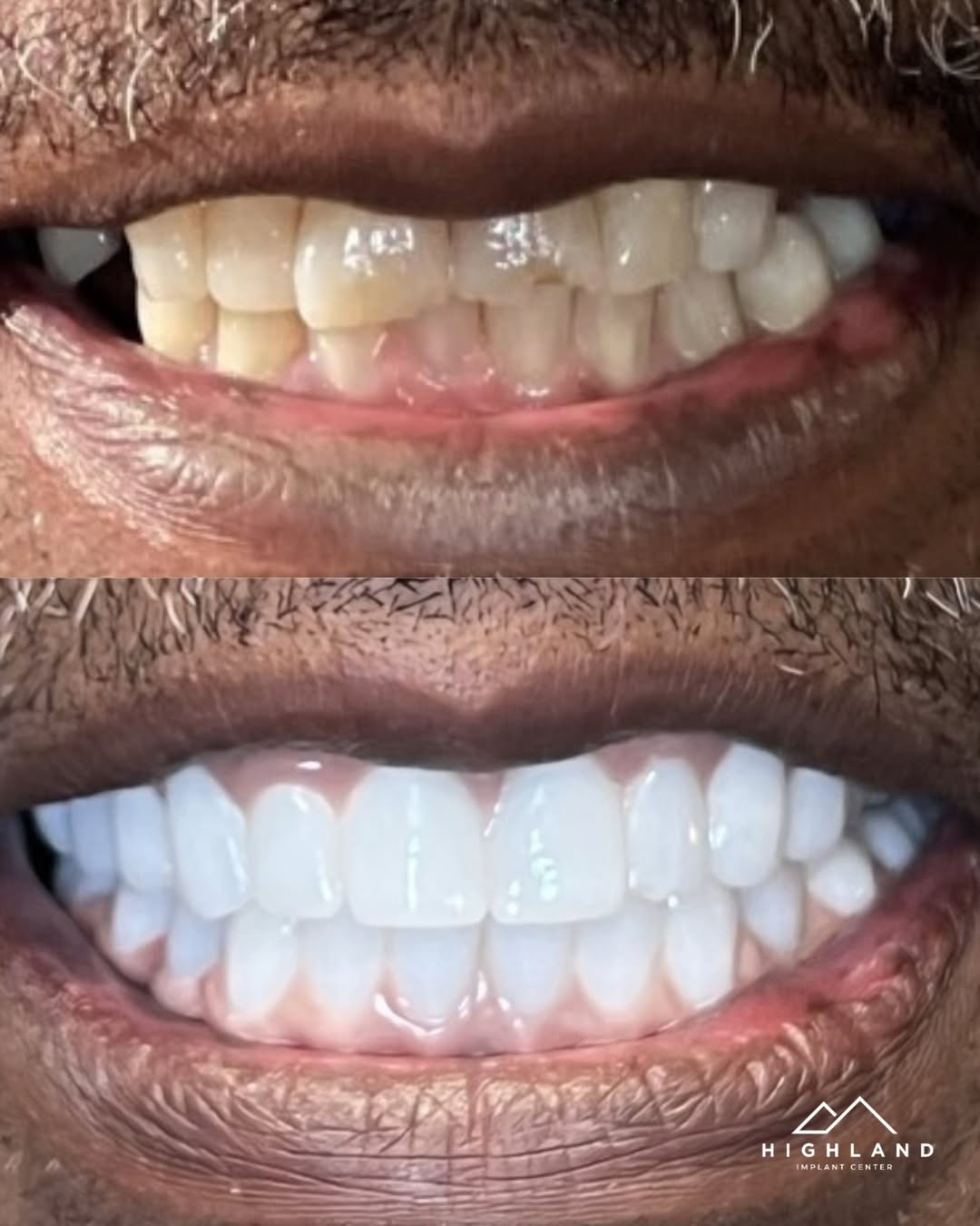 Dental implant patient before and after result 6, Highland Implant Center
