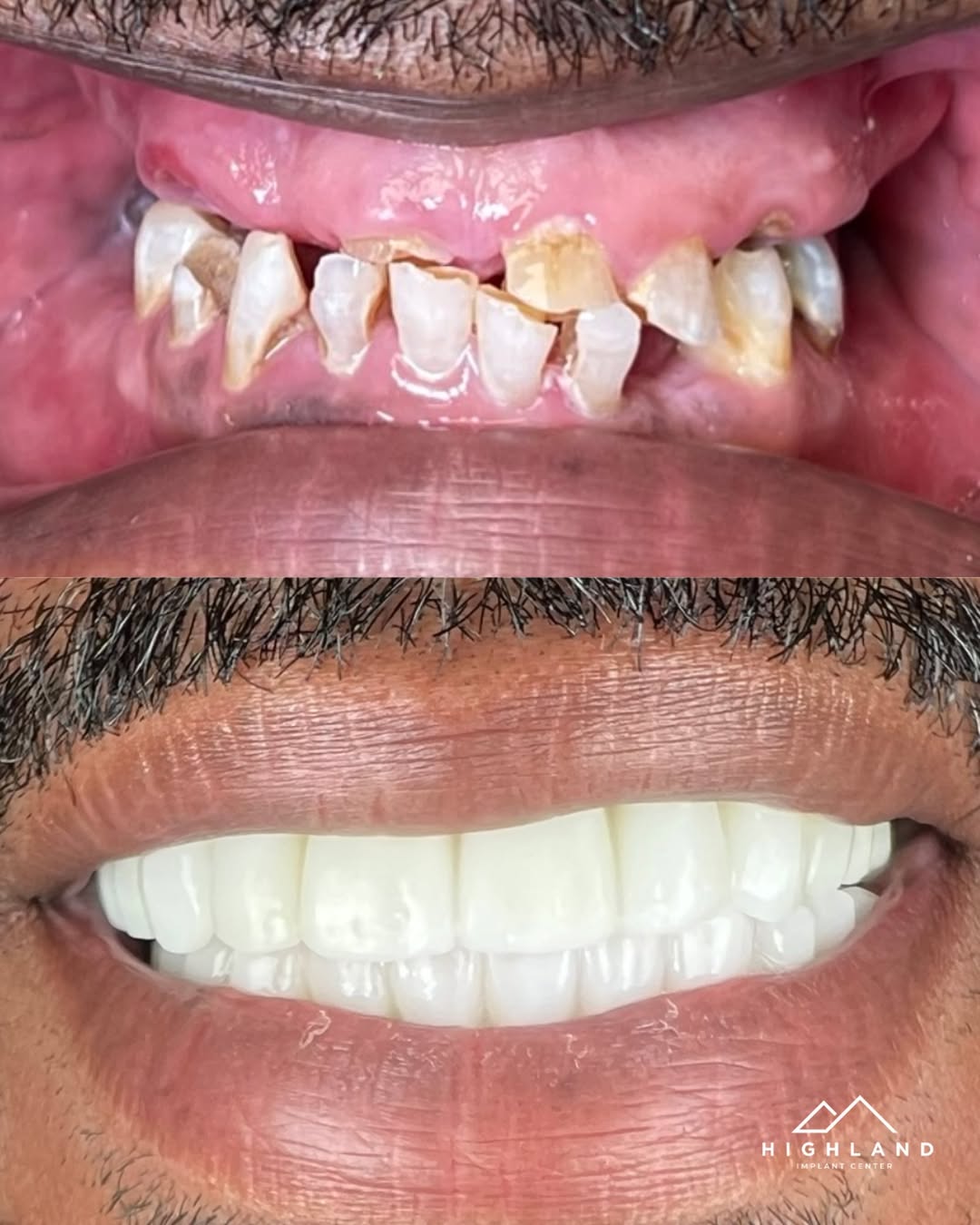 Dental implant patient before and after result 8, Highland Implant Center