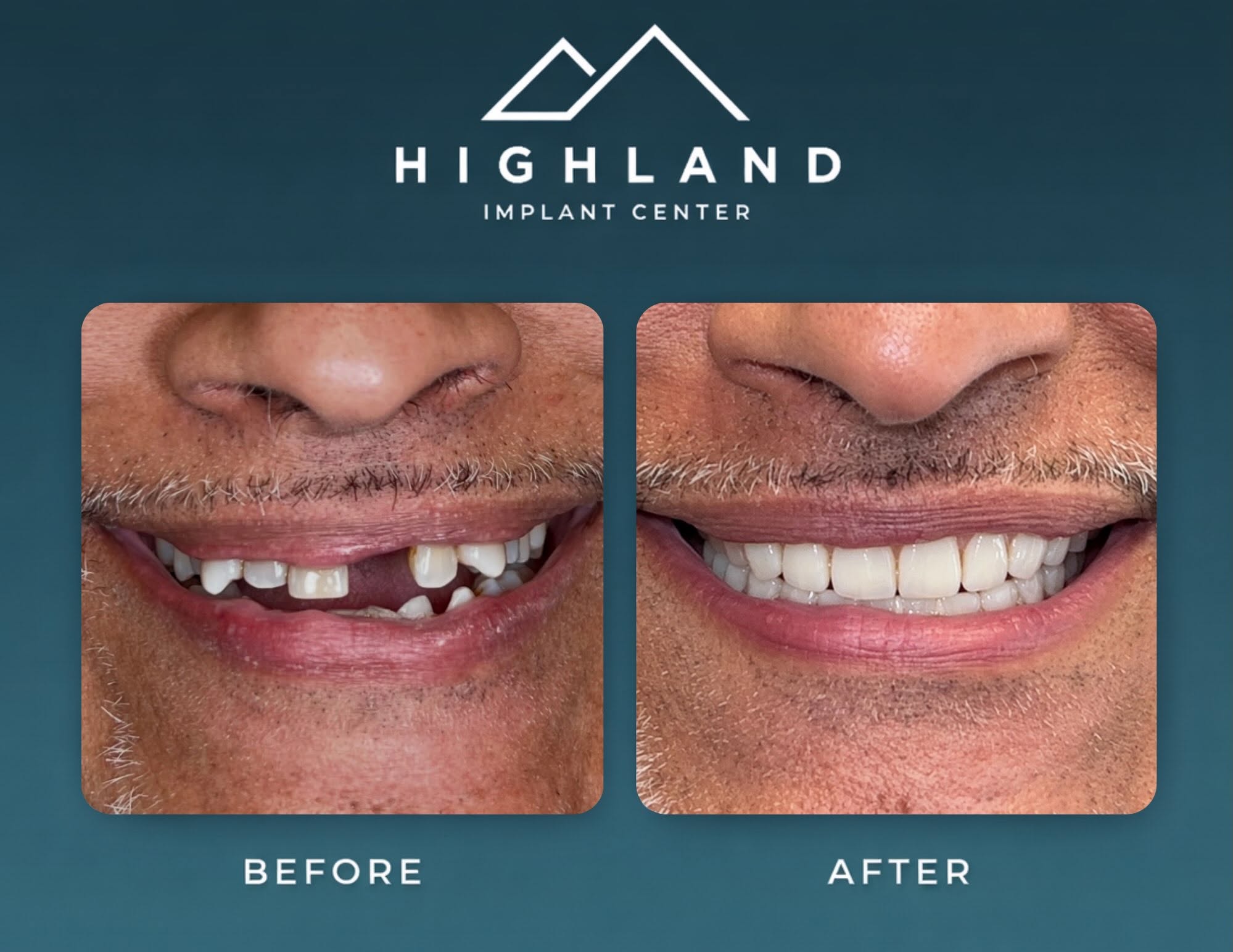 Dental implant patient before and after result 1, Highland Implant Center