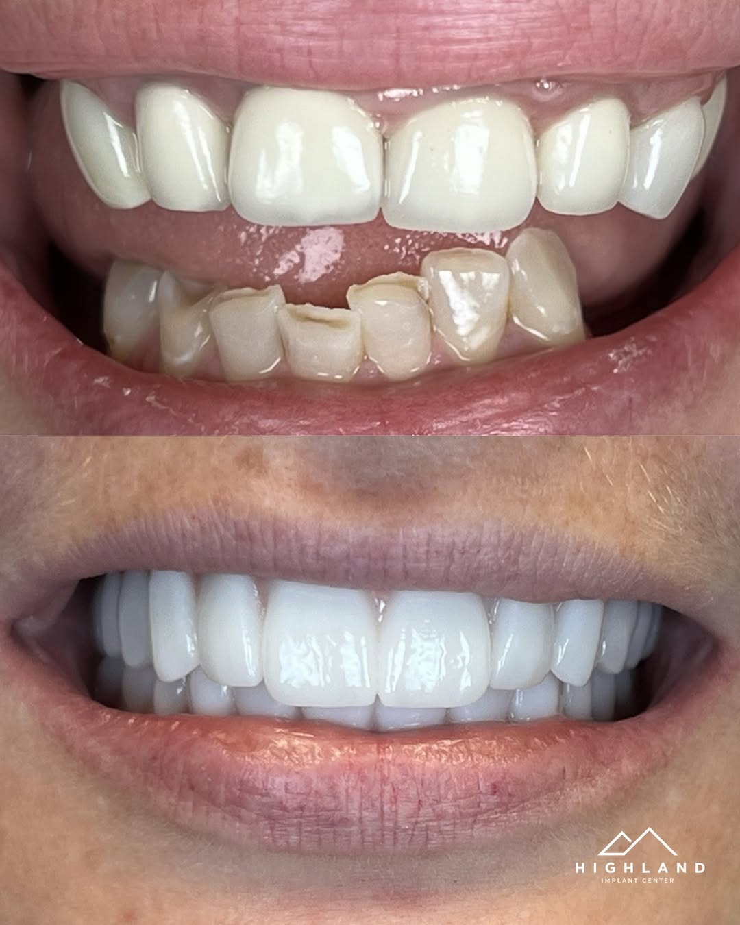 Dental implant patient before and after result 7, Highland Implant Center