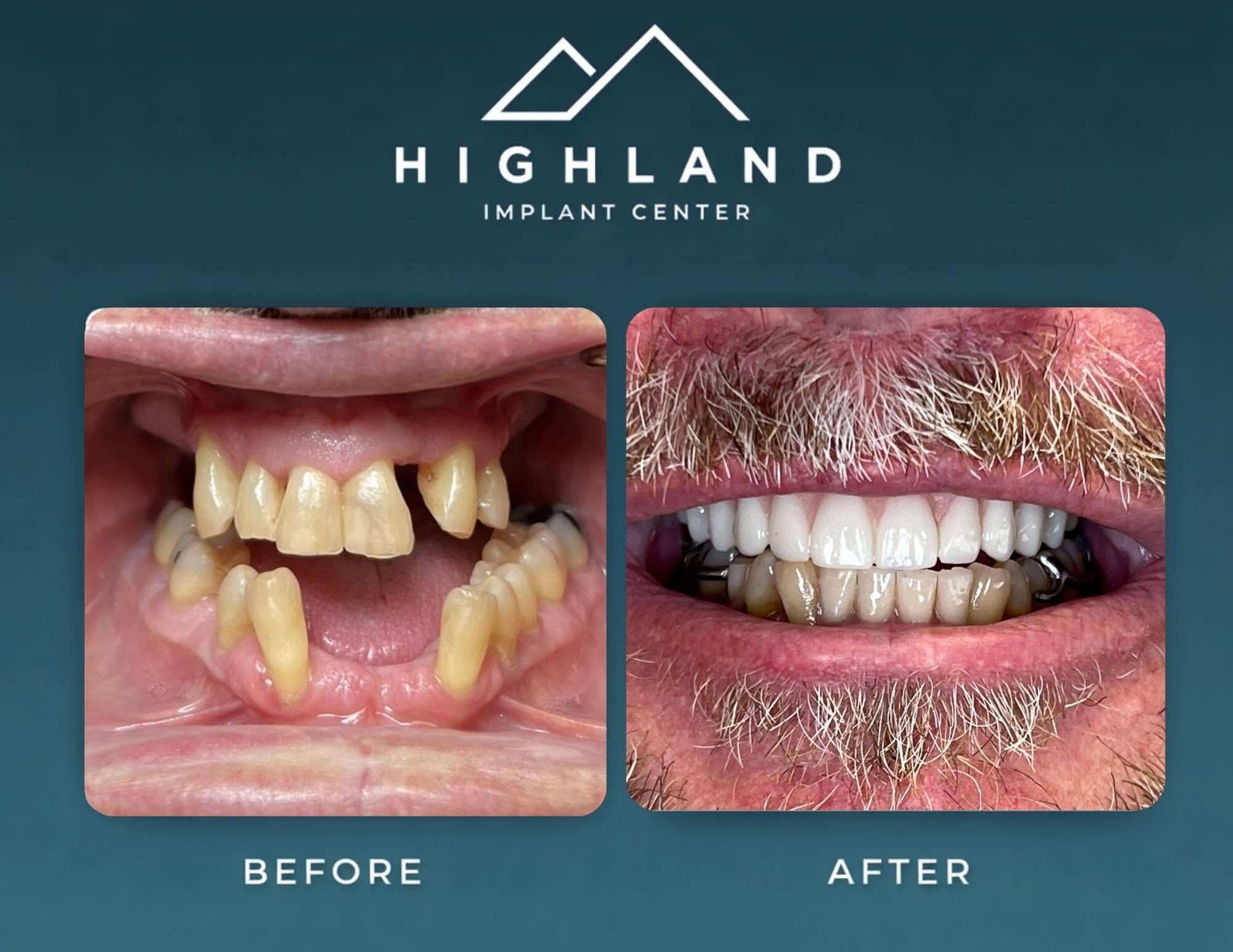 Dental implant patient before and after result 5, Highland Implant Center