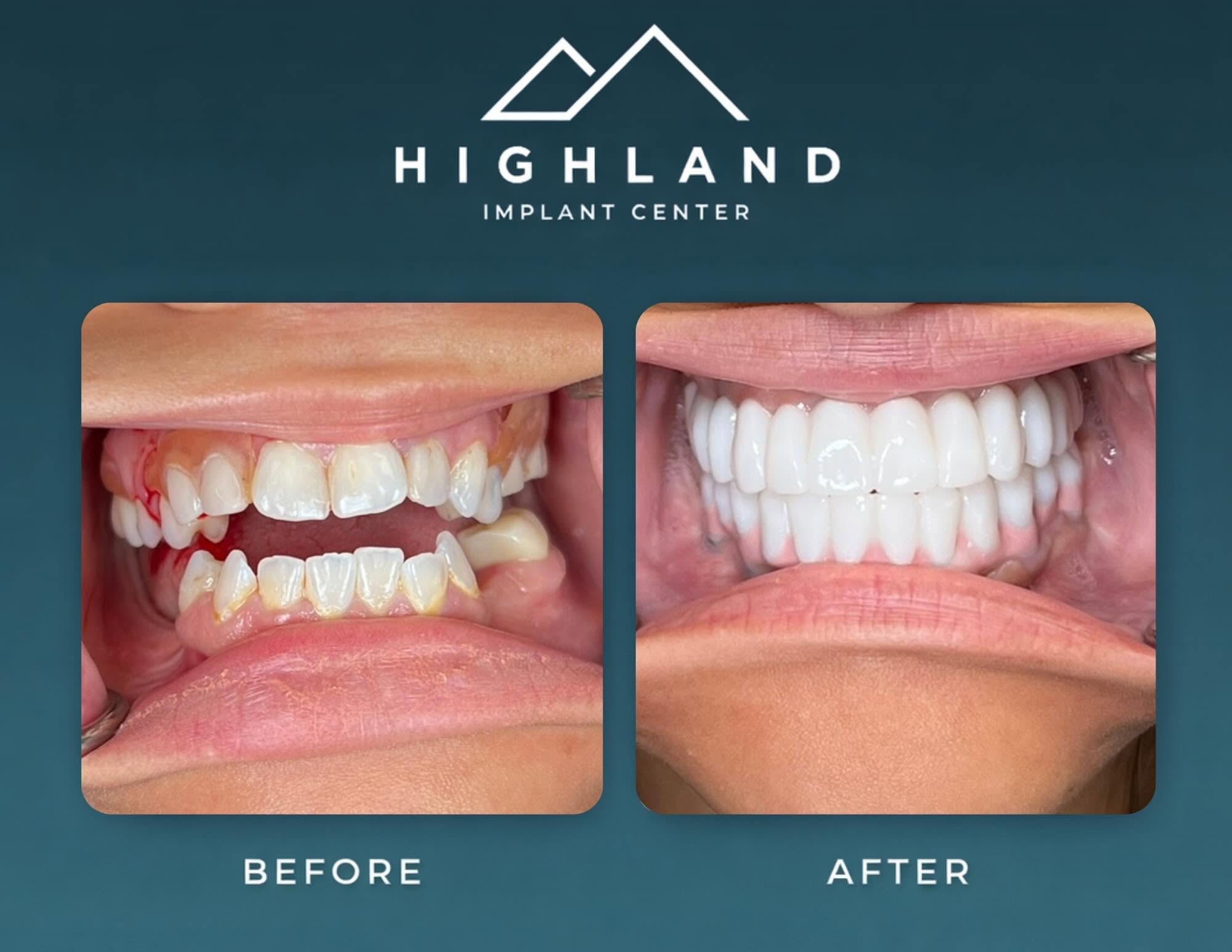 Dental implant patient before and after result 4, Highland Implant Center