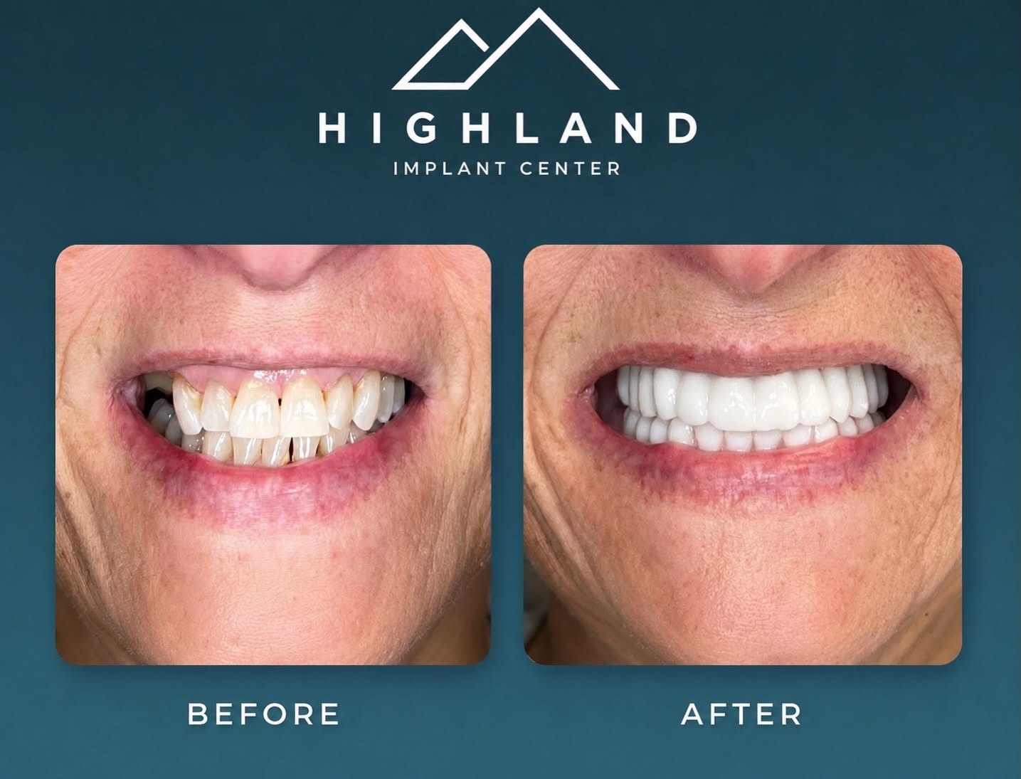 Dental implant patient before and after result 2, Highland Implant Center