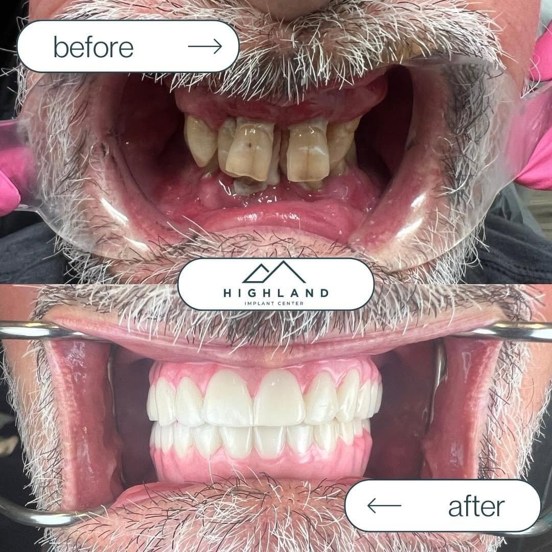Dental implant patient before and after result 3, Highland Implant Center