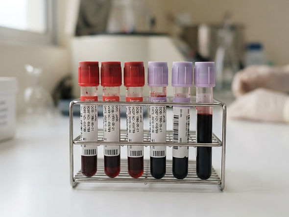 17181 ALDOSTERONE, LC/MS Blood Test